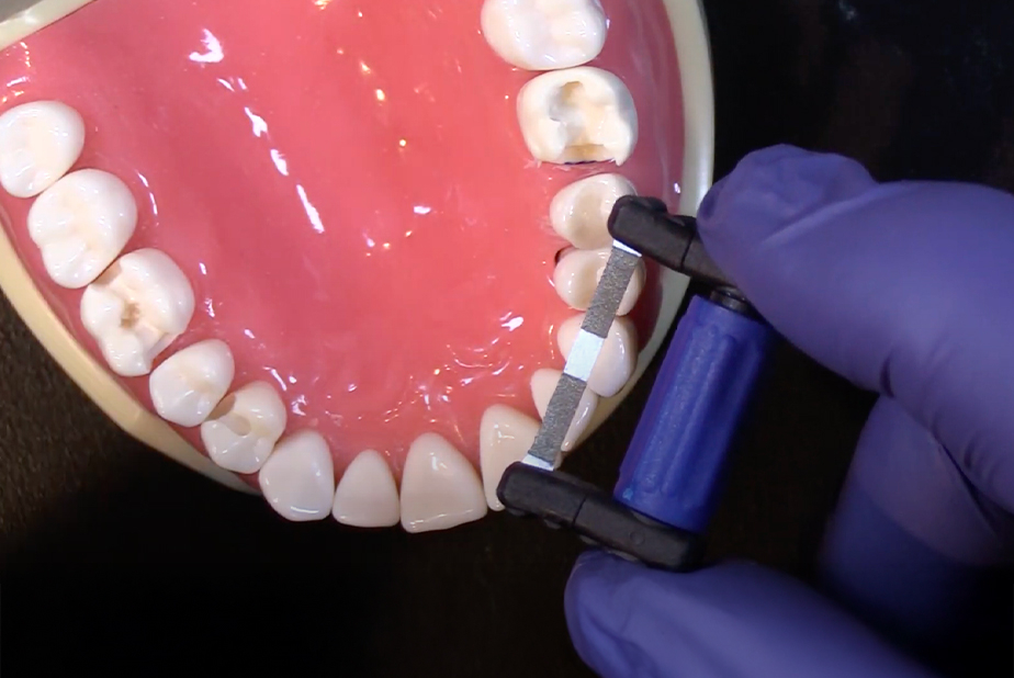 kit strisce subgengivali per finitura e modellazione FitStrip