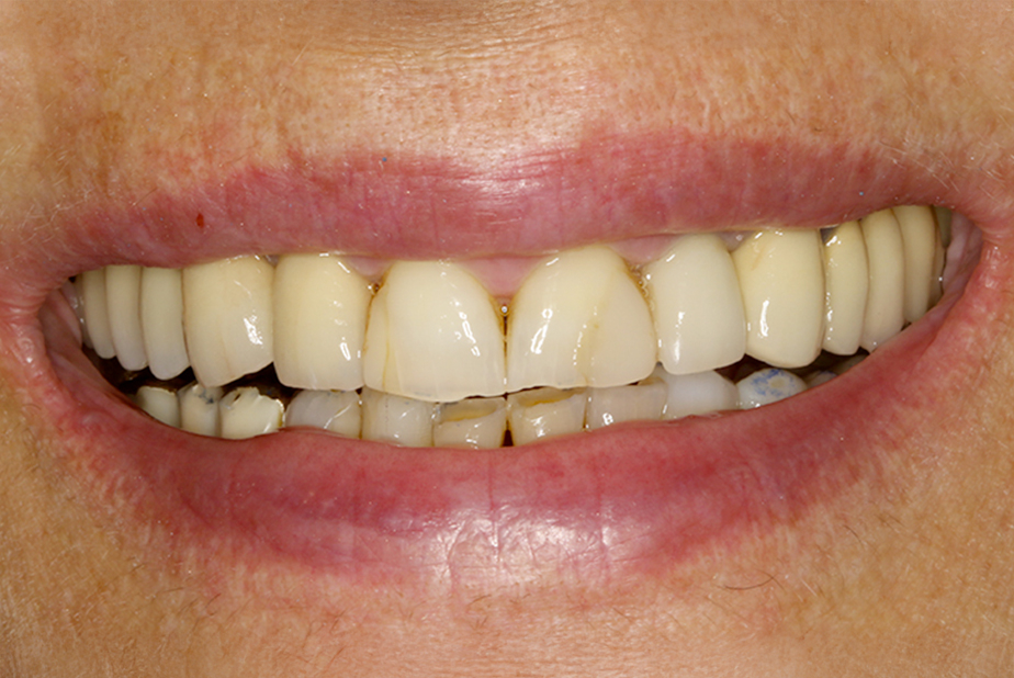 Riabilitazione del primo quadrante attraverso navigazione dinamica