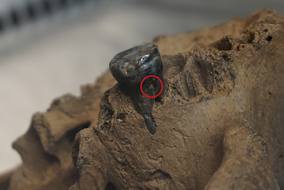 Trataro del cranio di Harbin