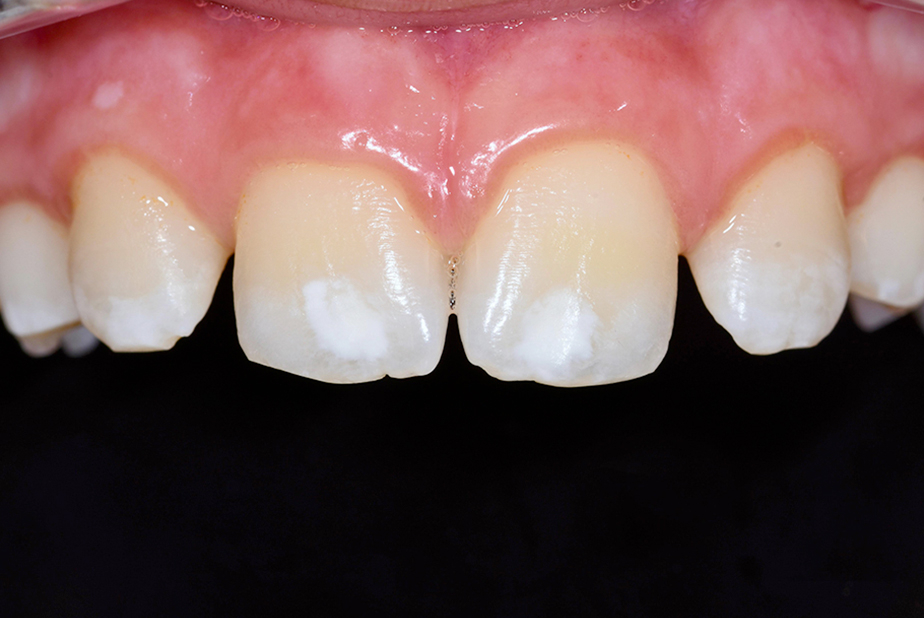 Discromie dentali tecniche di intervento