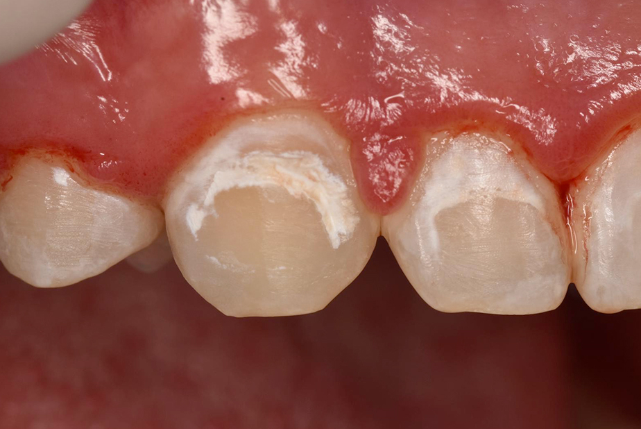 Curodont Repair approccio non invasivo alle lesioni cariosi iniziali