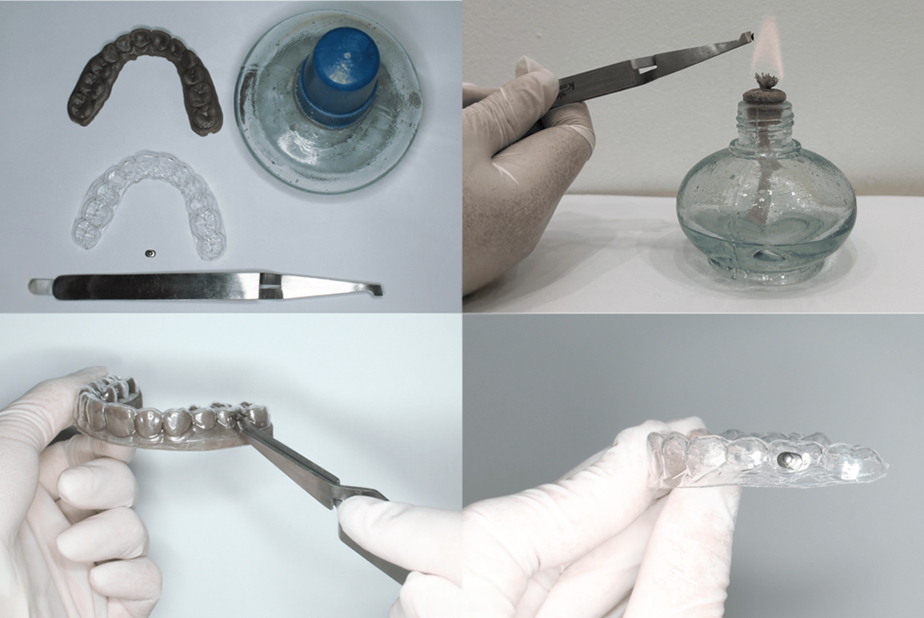 Bottoni sugli allineatori trasparenti