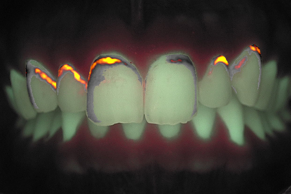 Infiltrazione resinosica per il trattamento non invasivo delle lesioni ipocalcifiche